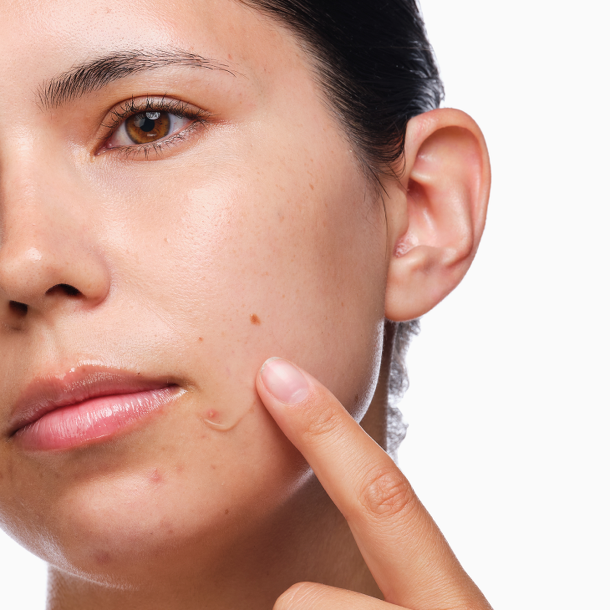 the-acne-set-y1 rdn-the-acne-set-application.png