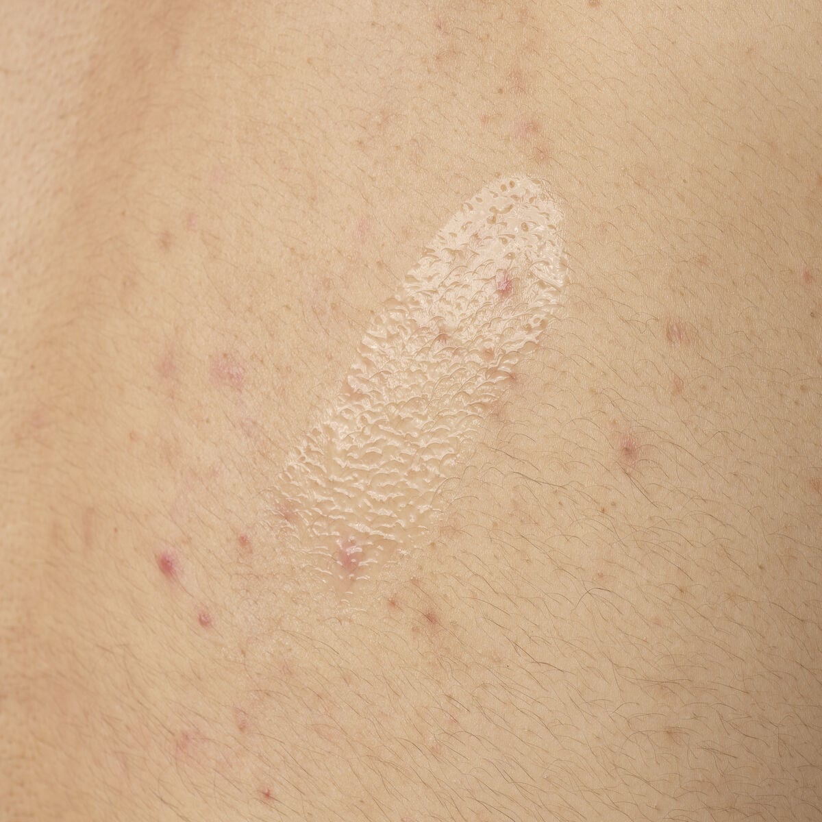 salicylic-acid-0-5-body-serum-t0 ORD-salicylic-acid-05-body-240ml-application.jpg