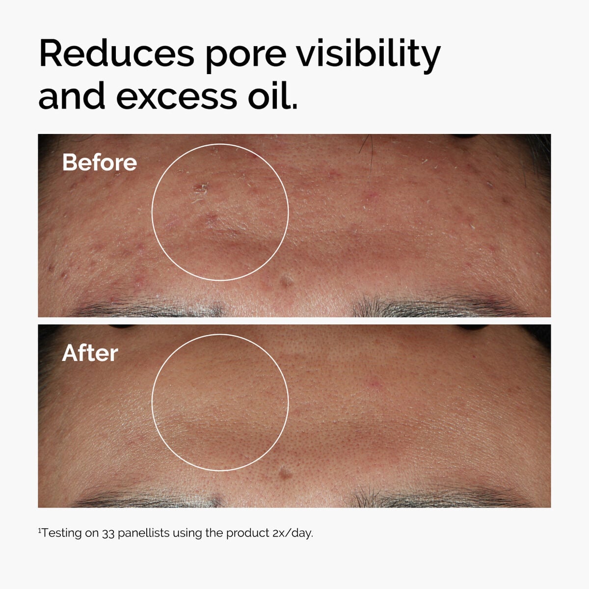 niacinamide-10-zinc-1-m8 ord-niacinamide-zinc-blemish-serum-before-after-pores.jpg