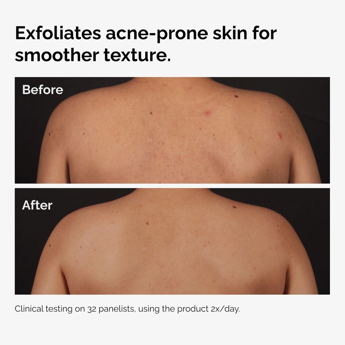 salicylic-acid-0-5-body-serum-t0 ord-salicylic-acid-body-serum-before-after-graphic-NA.jpg