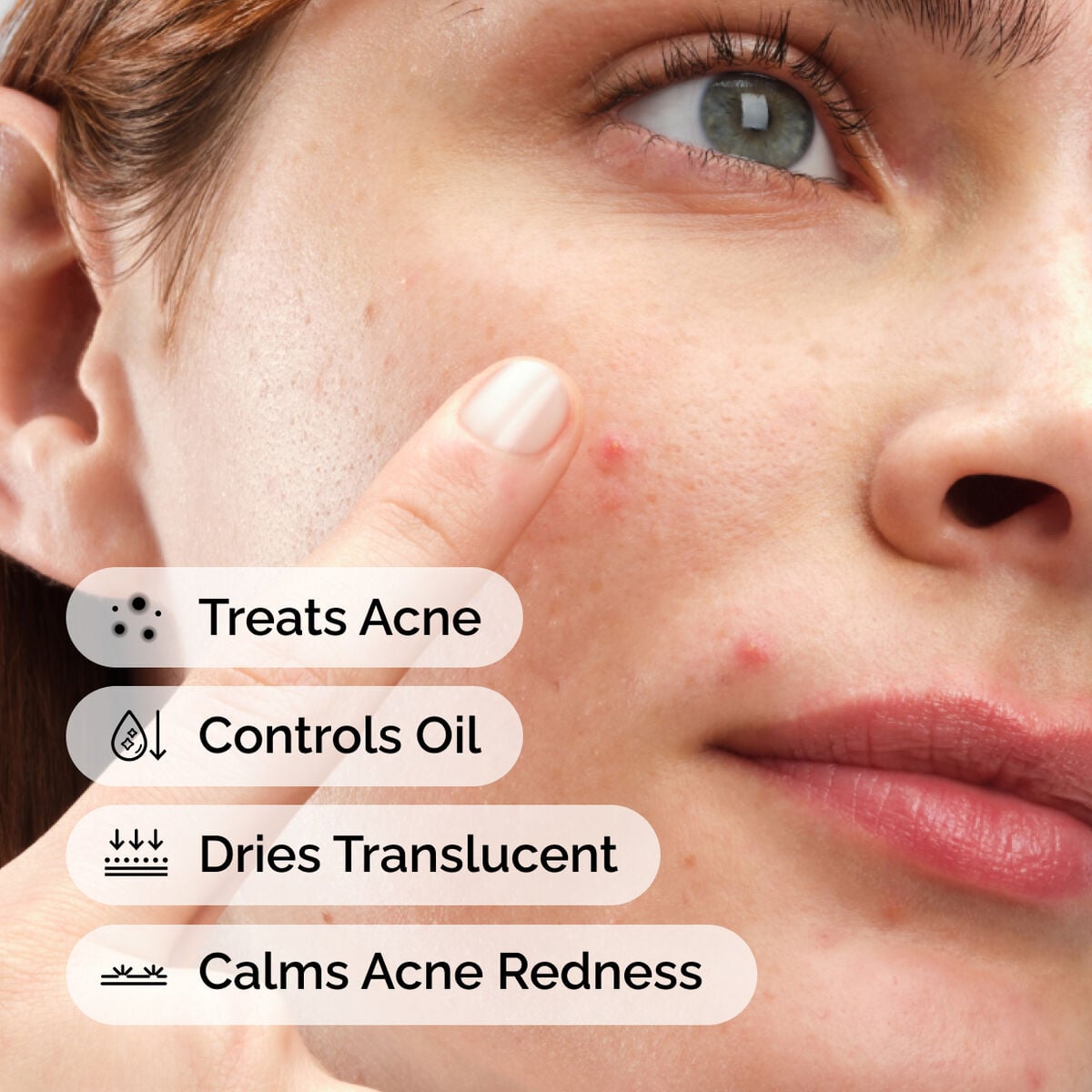 sulfur-10-powder-to-cream-concentrate-v7 ord-sulfur-10pct-powder-to-cream-concentrate-model-application-with-benefits-acne.jpg